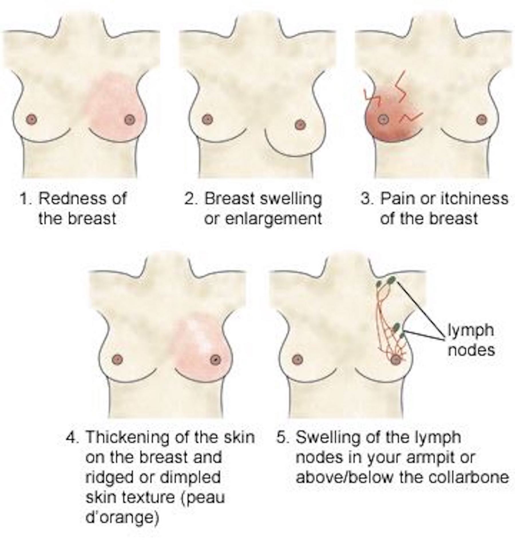 Itchiness In This Area Could Be A Sign Of Breast Cancer
