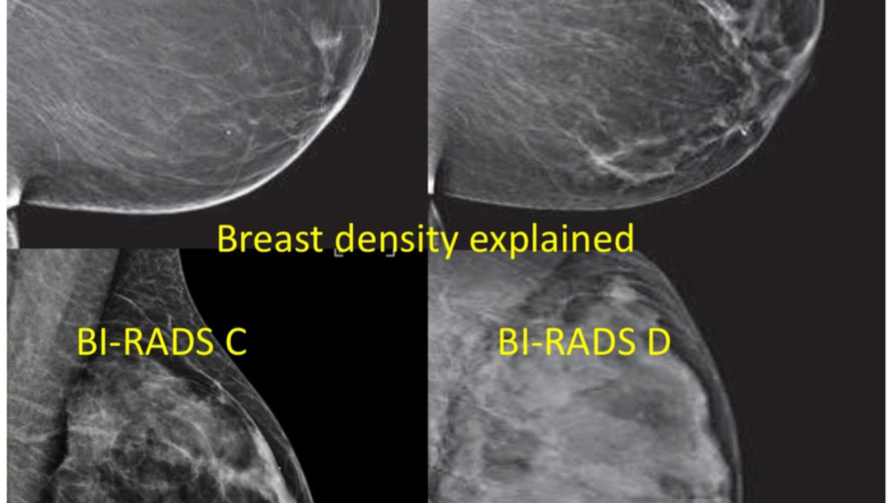 Images of dense breast