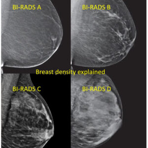Images of dense breast