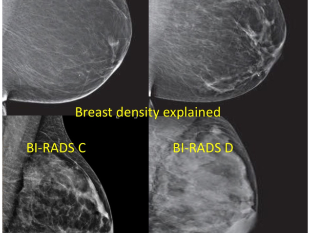 Images of dense breast