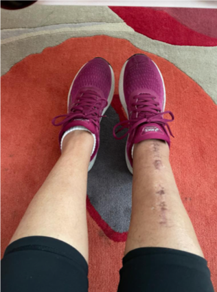 Picture of Del's new trainers to train for the Moonwalk and scar from broken leg