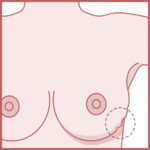 Skin indentation on the breast is an important factor of breast cancer