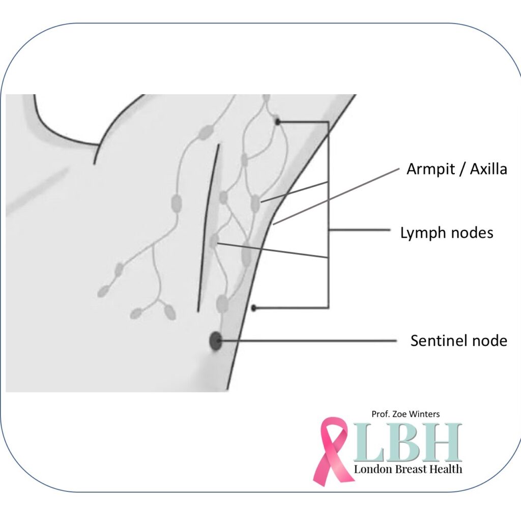 Sentinel Lymph Node
